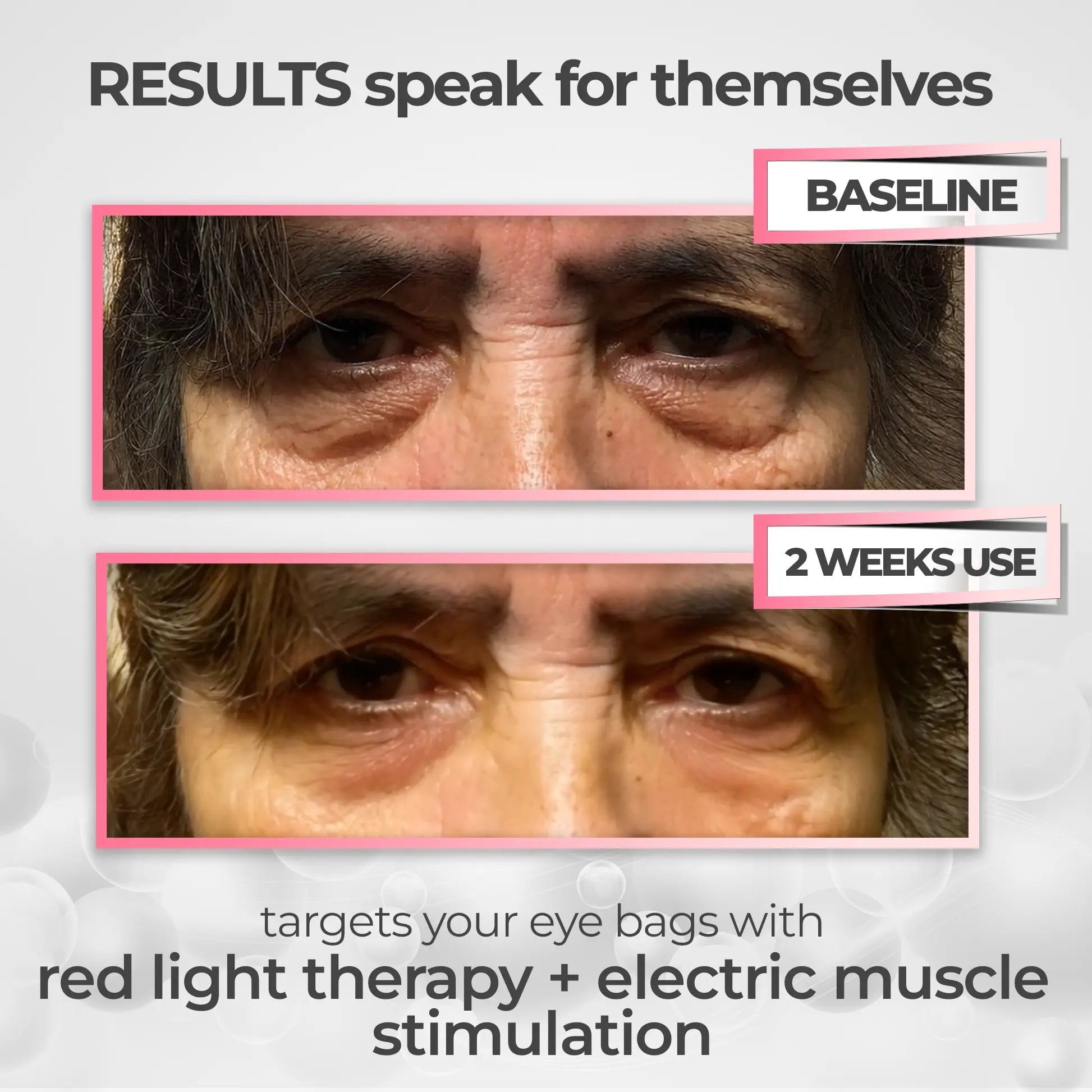 RevitaEyes® 2-in-1 Red Light Therapy + EMS To Erase Eye Bags