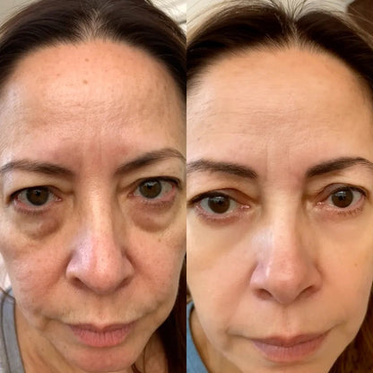 RevitaEyes® 2-in-1 Red Light Therapy + EMS To Erase Eye Bags
